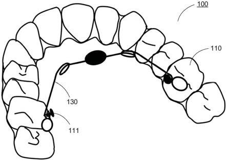 壳状牙科器械及扩弓簧的制作方法