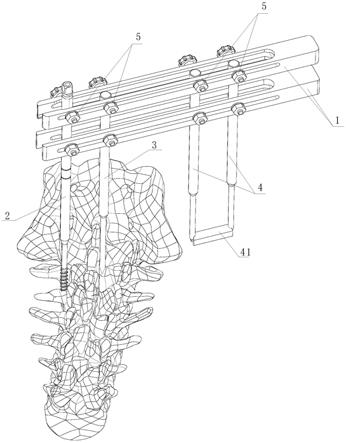 一种棘突椎板关节突螺钉用导向器及其使用方法与流程