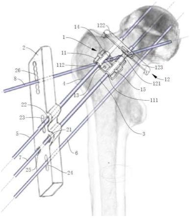 用于股骨颈骨折开放复位的螺钉导向器及其使用方法