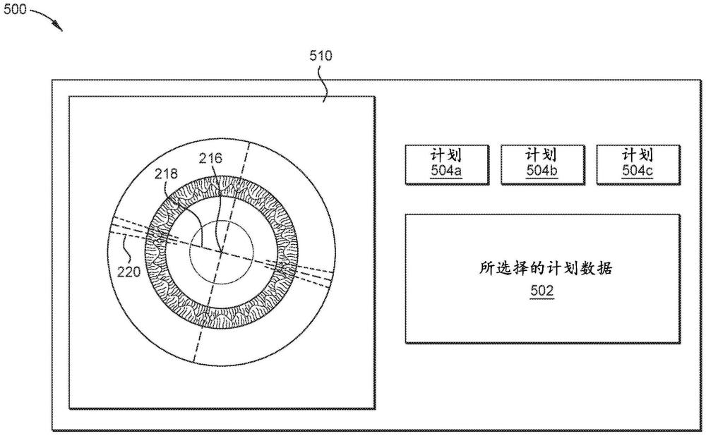 用于指导眼科手术的具有替代方案的计算机化治疗计划的制作方法