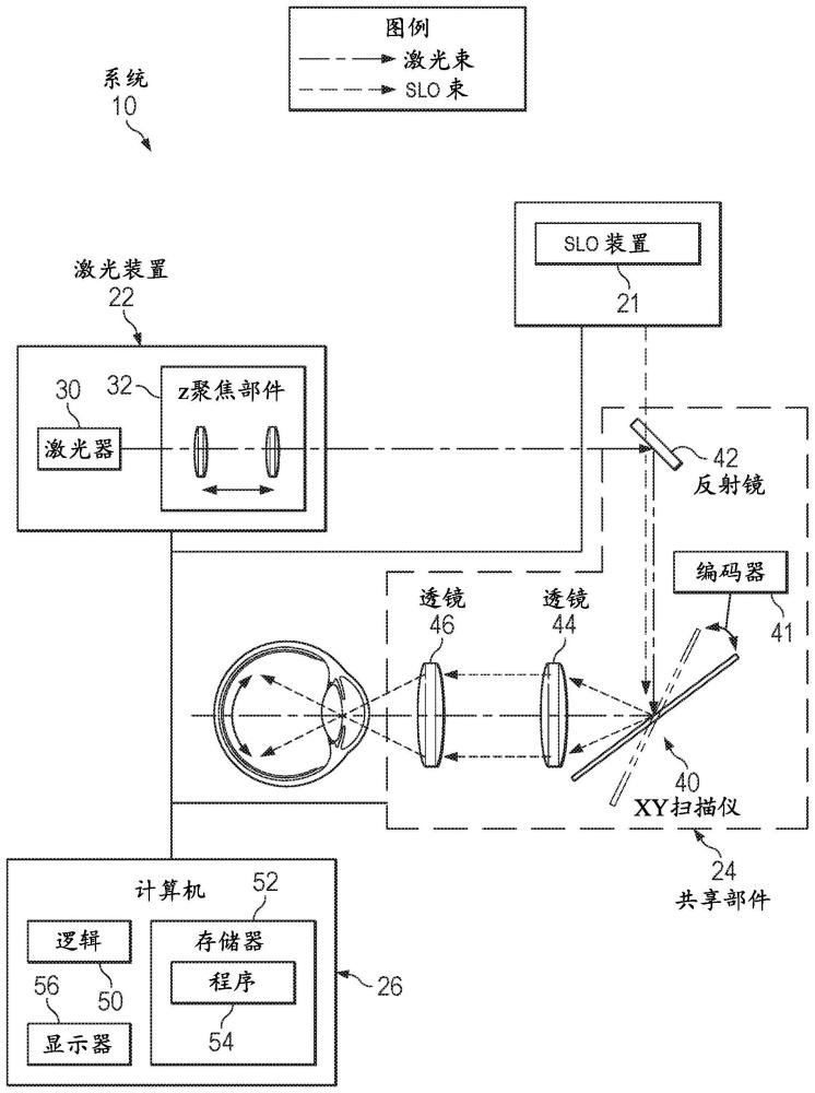 用于激光玻璃体消融术的激光扫描检眼镜激光引导的制作方法