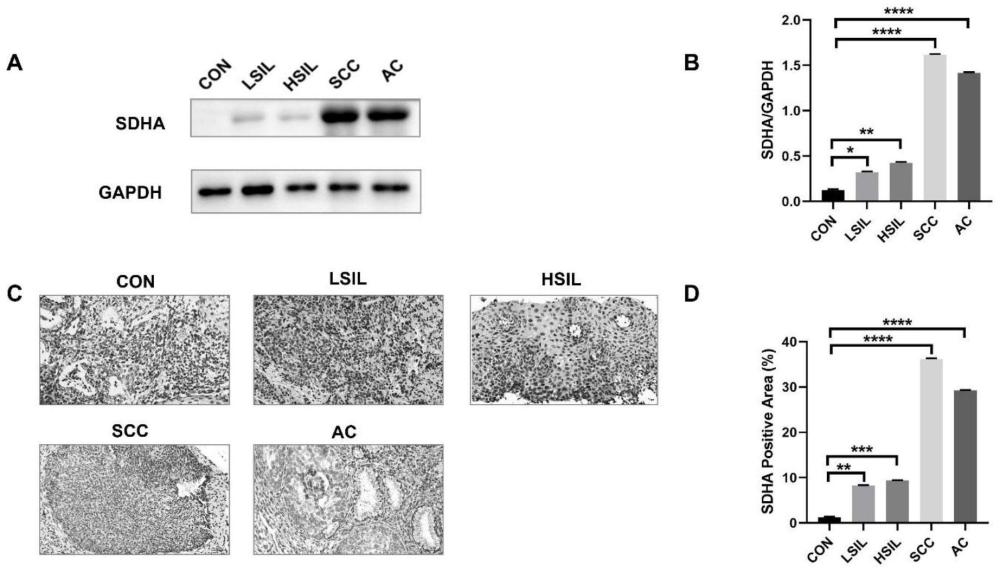 SDHA在宫颈癌诊断和作为治疗靶点中的应用