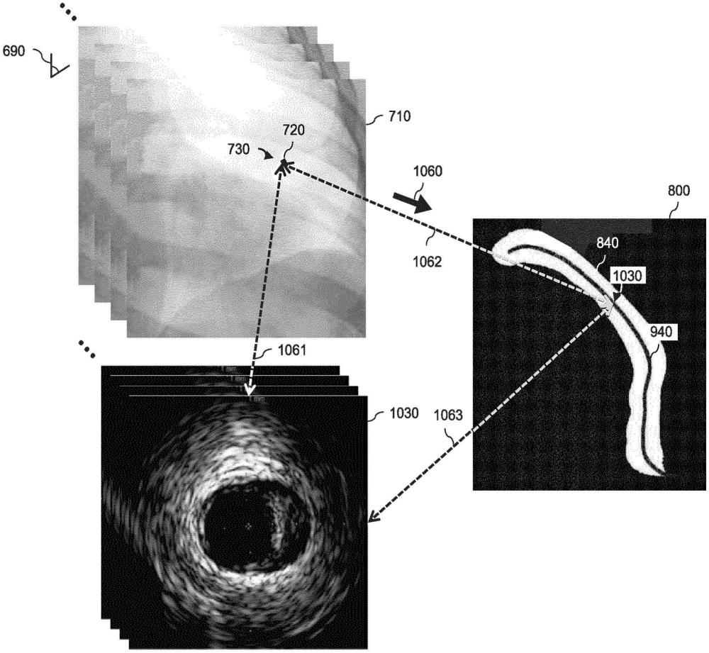 将管腔内数据与无造影X射线图像帧共配准及相关联的系统、设备和方法与流程