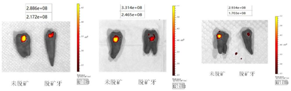 一种AIE-DSS荧光探针及其制备方法和在早期龋检测中的应用