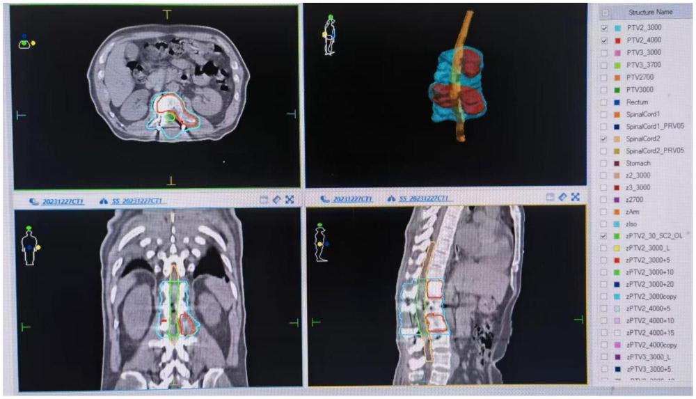 一种基于螺旋断层治疗的脊髓安全受照剂量优化系统
