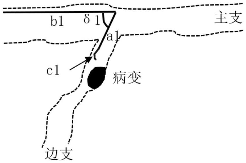 一种冠状动脉预塑形的反折导丝及其制备方法